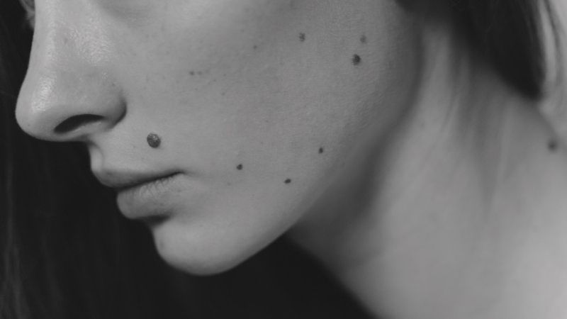 Benign Moles Removal FAQs Guildford Guildford