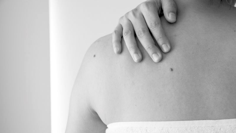 Who Is Suitable for Benign Mole Removal Guildford? Guildford