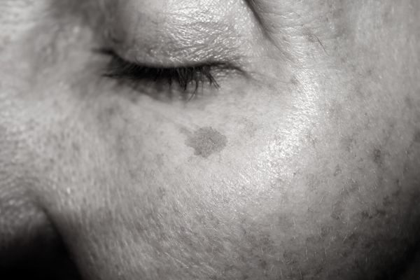 Age Spots Removal in Guildford&ndash; Clear, Even-Looking Skin at Home Guildford