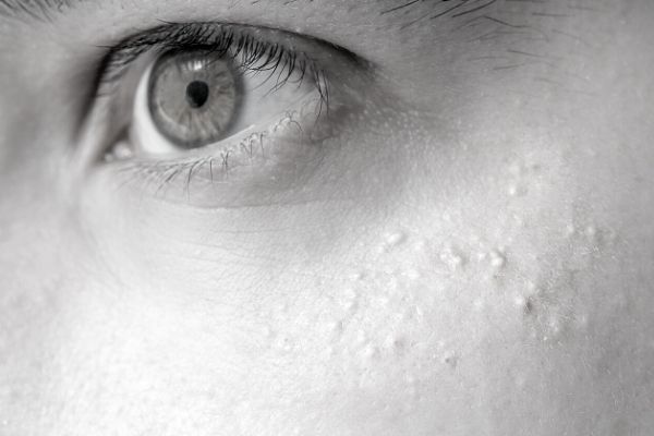 Aftercare Advice Following Milia Removal Guildford Guildford