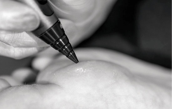 Warts Aftercare Advice for Faster Healing Guildford