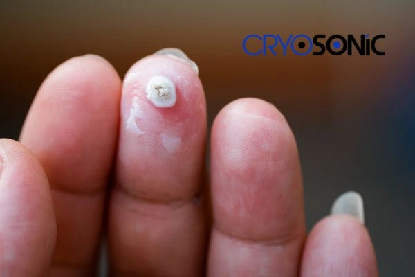 Learn more about us Guildford at Cryosonic. Book in today! Guildford