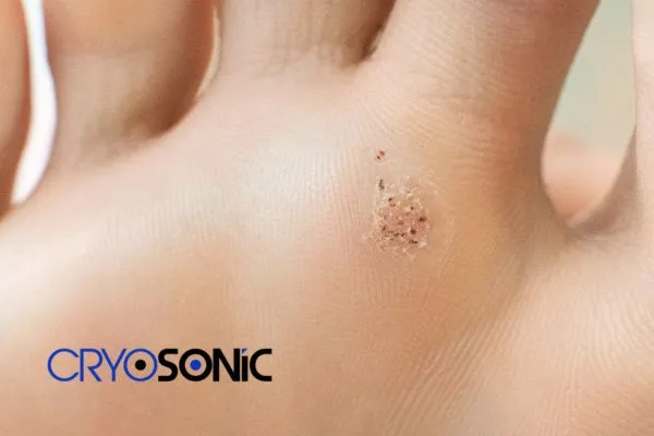 Book in your Verrucae removal treatment today Guildford Guildford