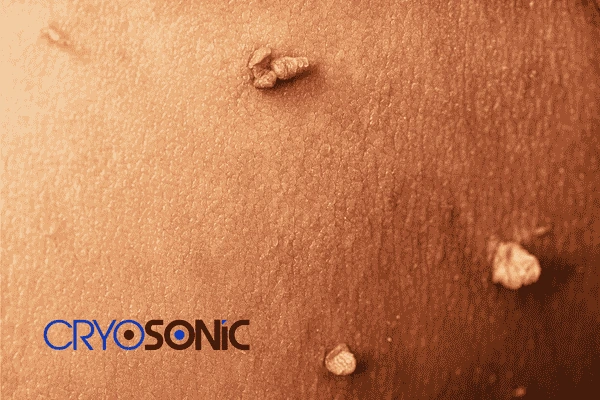 Do you want to get skin tags removal Guildford? Contact our team today! Guildford