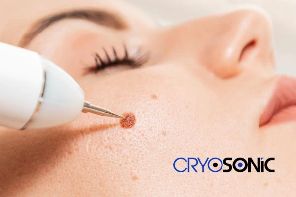 why choose us at Cryosonic for blemish removal? Find out more now Guildford