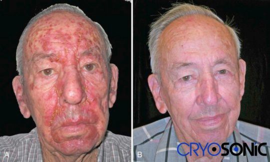 Actinic Keratosis Treatment before and after results Guildford Guildford