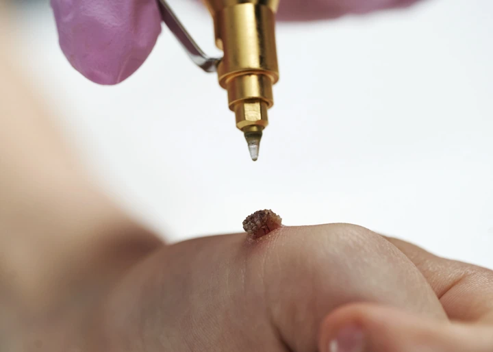 Cryopen For Children Bristol Guildford