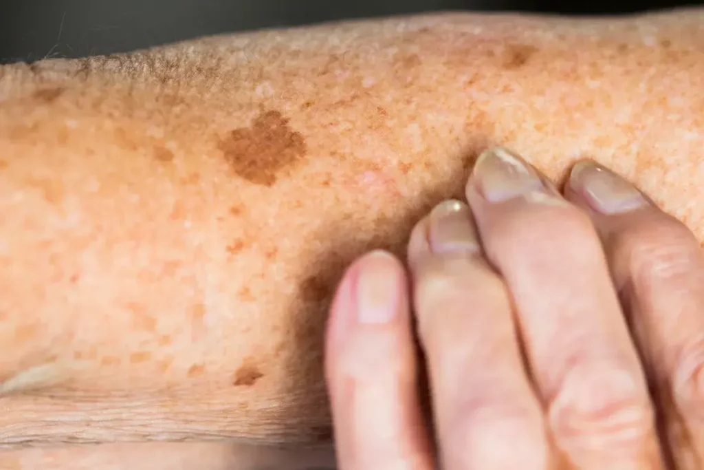 Sun Damage Aftercare and Skin Recovery Guildford