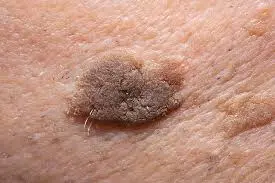 Recovery and Aftercare Advice after Seborrhoeic Keratosis Guildford