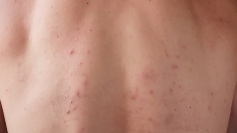 Molluscum Contagiosum Aftercare Advice for Faster Healing Guildford