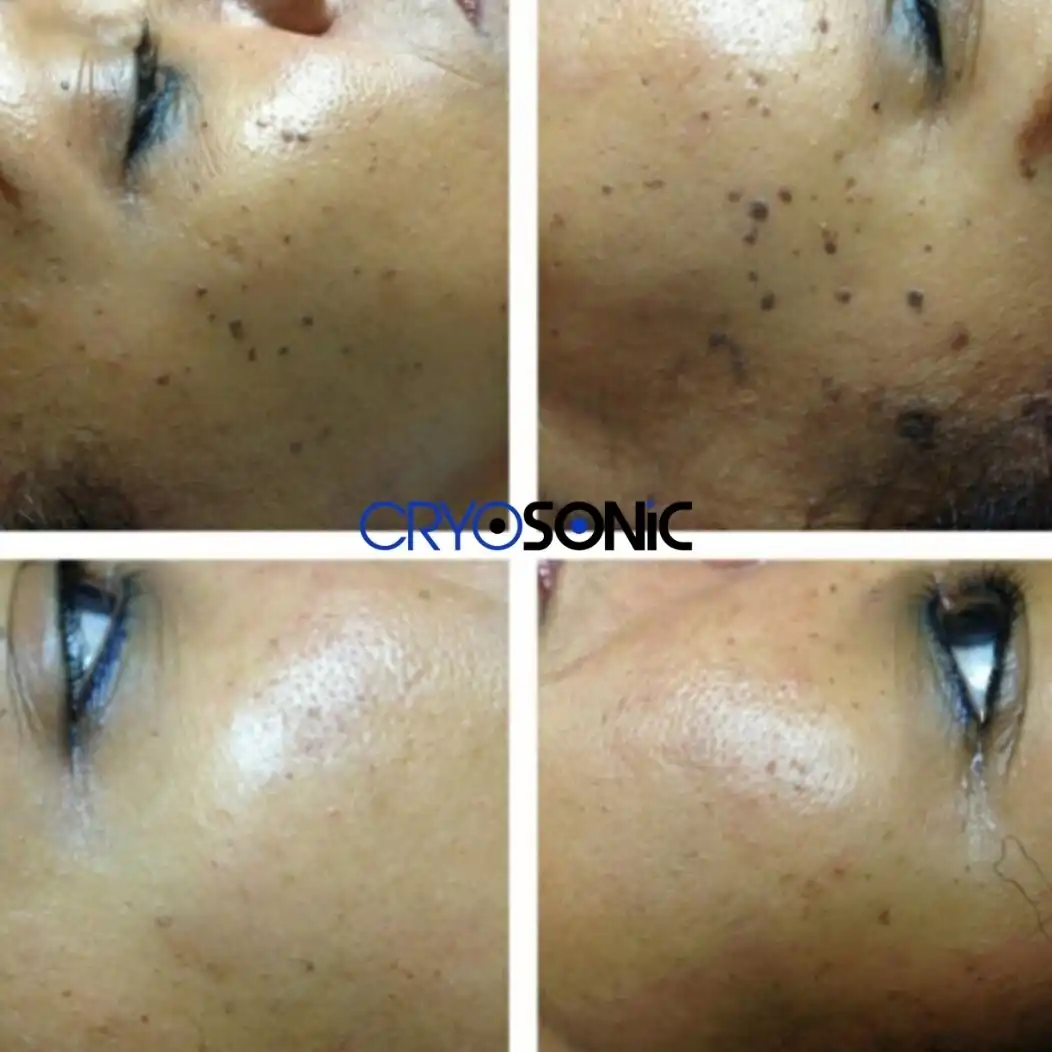 Why Skin Shows Pigmentation After Treatment Guildford