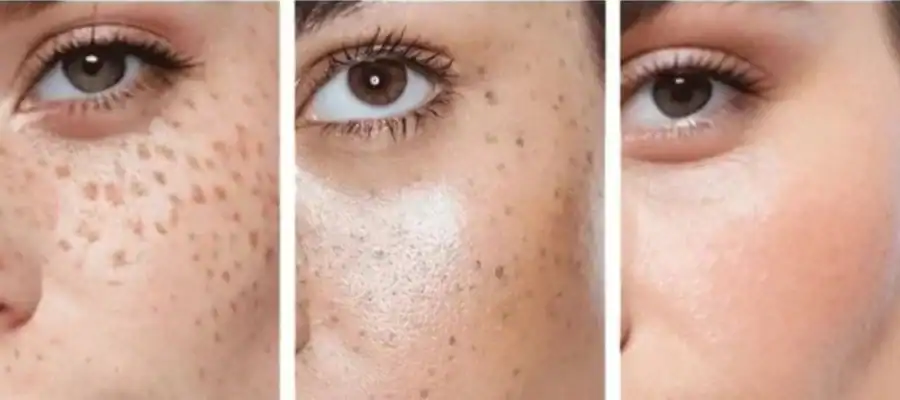 Ephelides Removal Results and Healing Timeline Guildford