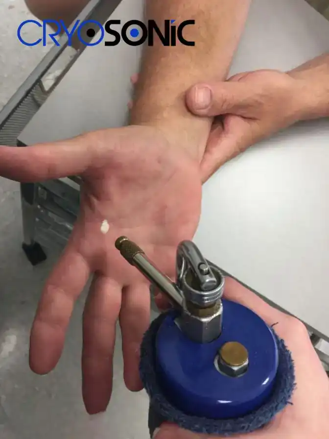 Temperature Differences: OTC vs Medical-Grade Cryotherapy Guildford